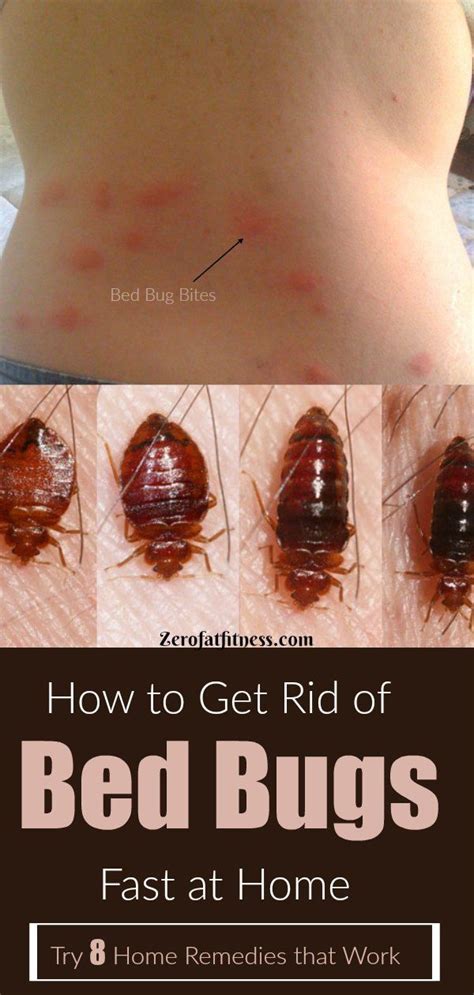 Get rid of bed bugs fast. Things To Know About Get rid of bed bugs fast. 